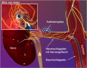 Abb.1 - Schematische Darstellung der Nierenarterienanatomie inklusive Nierenarteriendenervationskatheter und sympathischen Nervenfasern.
