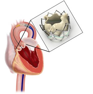 Abb.1 - Behandlung der Aortenklappen-Stenose durch Katheter-geführte Implantation einer neuen Herzklappe